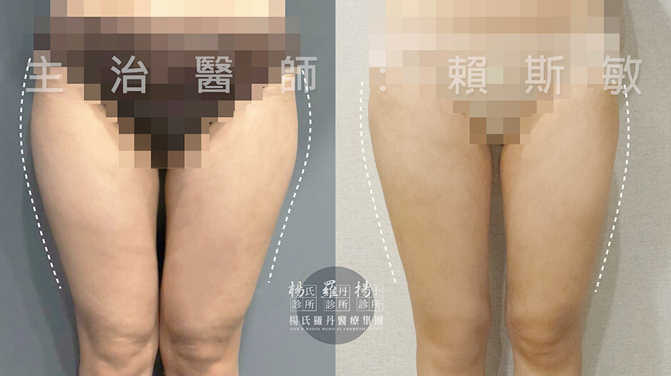 雷射減脂,楊氏羅丹,瘦大腿,賴斯敏